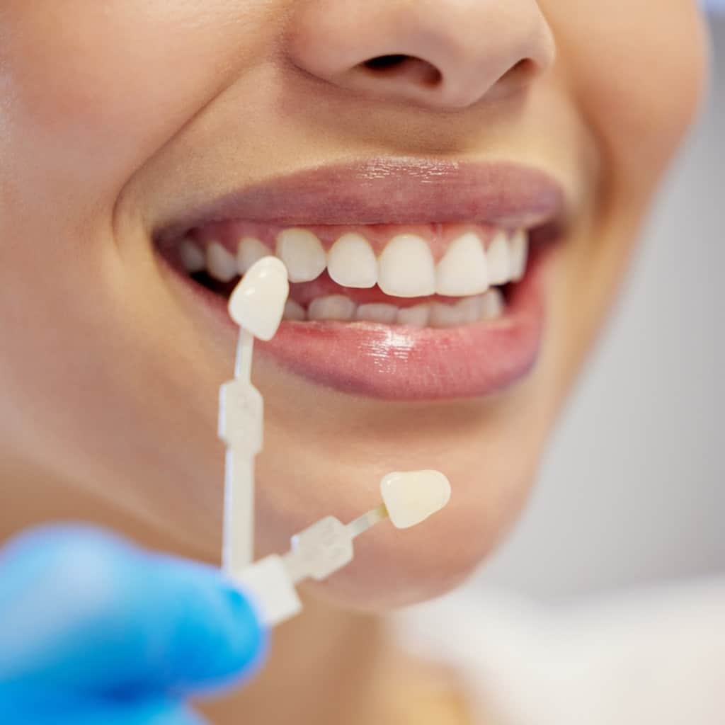 Dental Veneers London Ontario